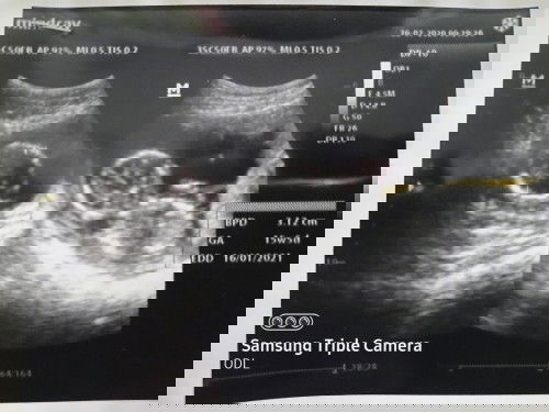 keluar flek kecoklatan bercampur cairan keputihan