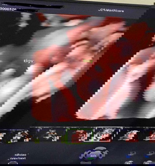 อัลตราซาวด์4มิติ