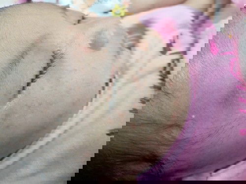 ผื่นขึ้นหน้า