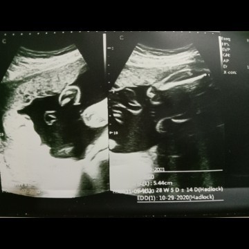 Ultrasound
