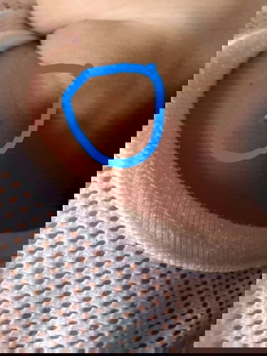 Lump on toddler's chest