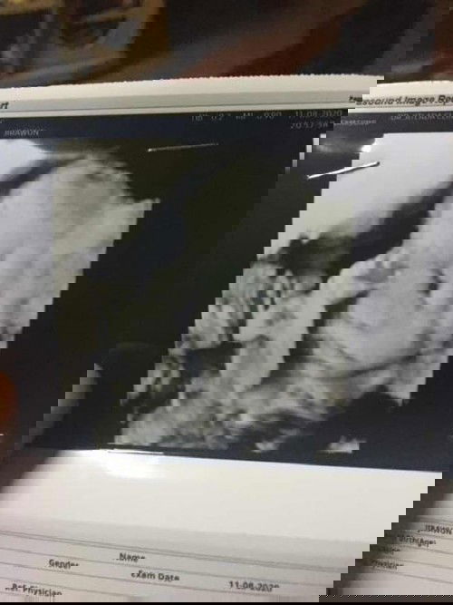 หมอที่ รพ.รัฐ ในใบซาวด์บอกเราว่าตั้งครรภ์ได้ 6เดือนกว่าจะ7เดือน หมอที่คลีนิคบอกดูในใบซาวด์ได้แค่6เดือน เรางงไปหมดตกลงจะเชื่อใครดีคะ