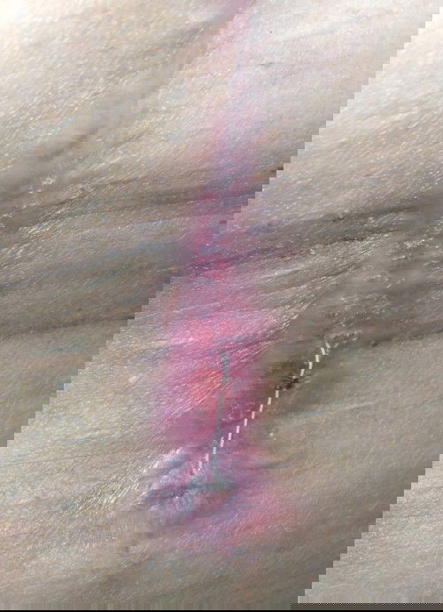 ผ่าคลอดแนวตั้ง