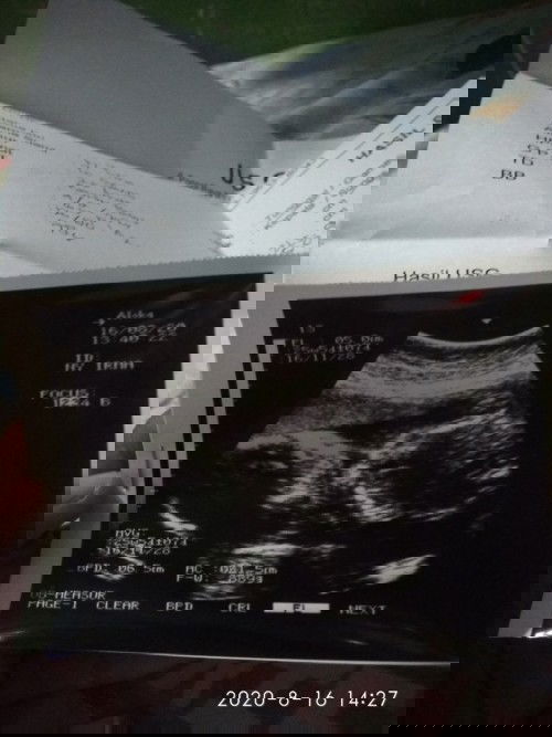 USG ke dua berubah hpl nya