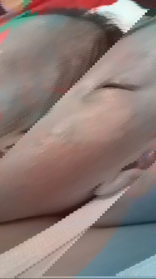 Beruntusan dan Kulit Kering