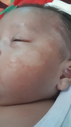 Beruntusan dan Kulit Kering