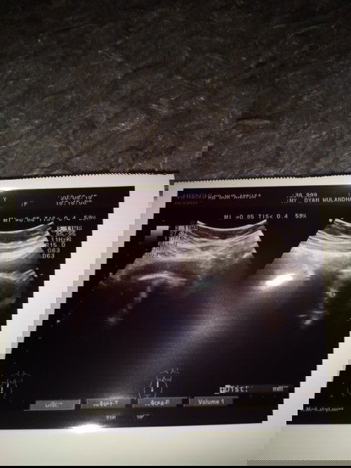 usg pertama kali....