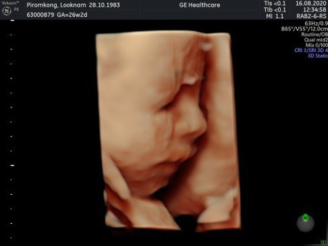 ได้เจอลูกชัดๆ