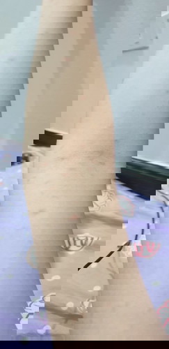 Rashes appeared