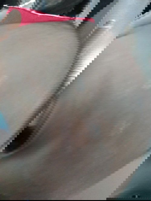 ลูกหน้าลอกเป็นขุยๆ ตอนแรกลอกแค่คิ้ว หลังๆลามมาหน้าผากแล้ว พอเอาสำลีชุบน้ำเช็ดออก ผิวจะขาวด่างๆ ต้องทำยังไงคะ  หรือเค้าจะหายเอง เริ่มเป็นตั้งแต่เดือนกว่าๆ ตอนนี้จะหกเดือนแล้วค่ะยังไม่หายเลย