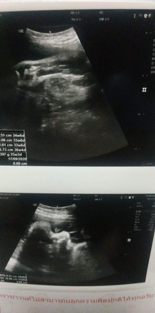 อัลตร้าซาวด์