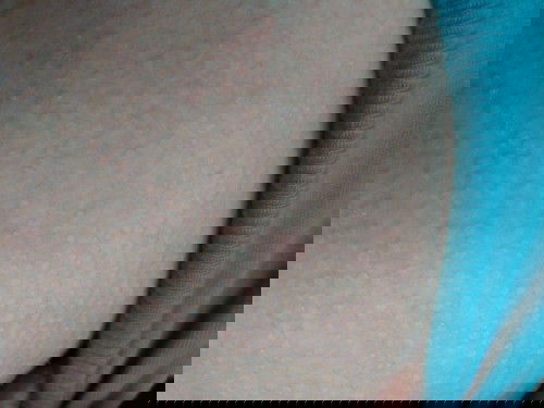 putih kaya panu dan menyebar cepat