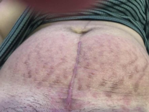 Itchy Stitches