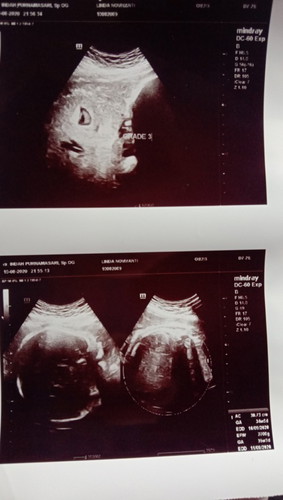 placenta bolong + ketubah keruh