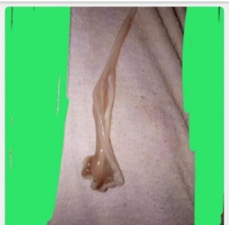 mucus plug
