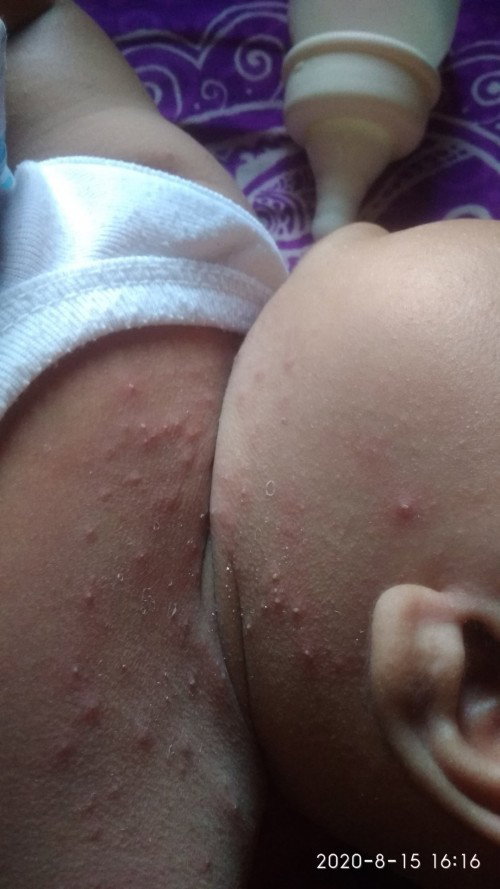 bintik merah di leher