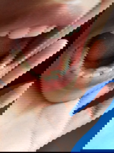 New Tooth of 5years old