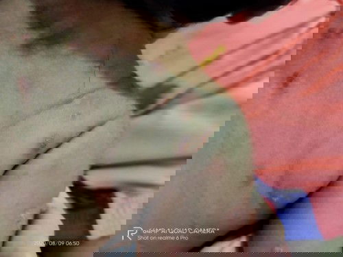 bintik bintik di kulit bayi