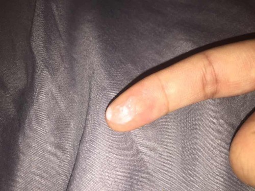 ตกขาวหรือมูก