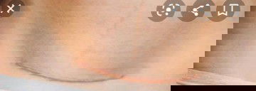 Menghilangkan keloid