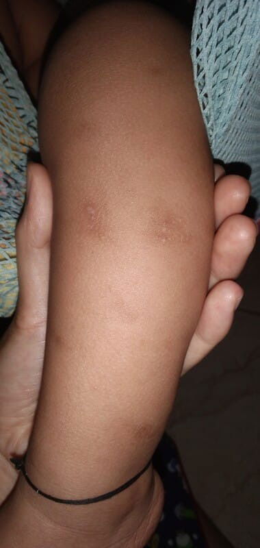 bekas Gigitan Nyamuk