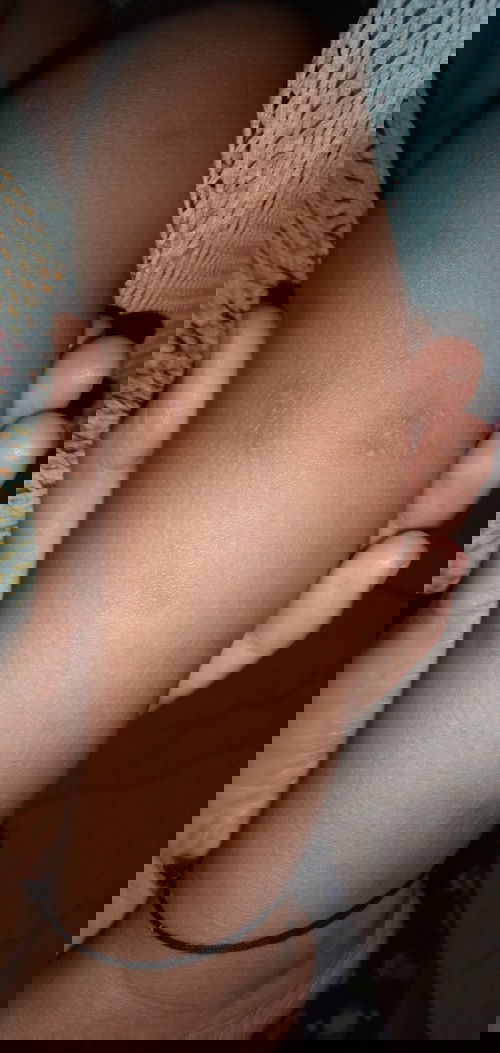 Bekas gigitan Nyamuk