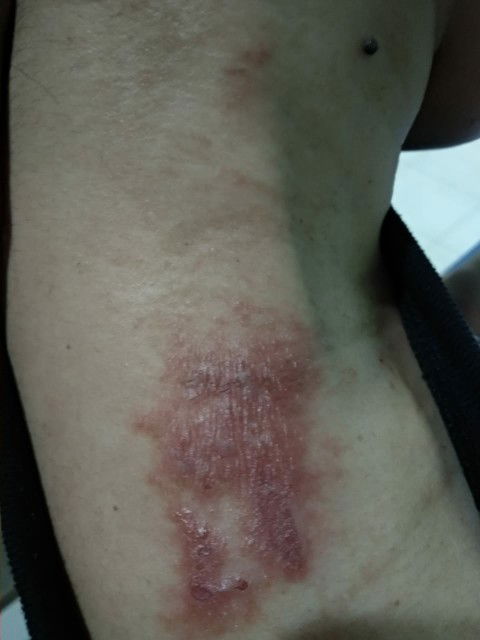 Ruam seperti melepuh saat hamil