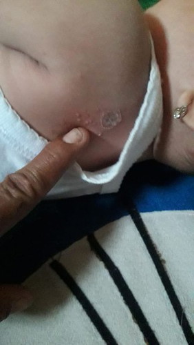 ruam bintik" dan besar