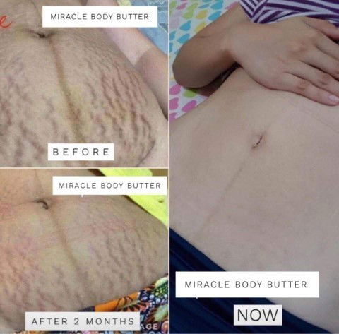 Stretch Marks? No problem. 😊