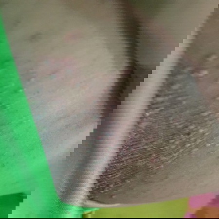 แผลตุ่มหนองข้างแคม