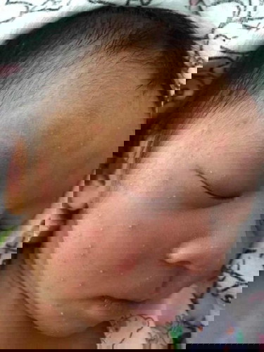 ผื่นขึ้นที่หน้า แต่ไม่คัน