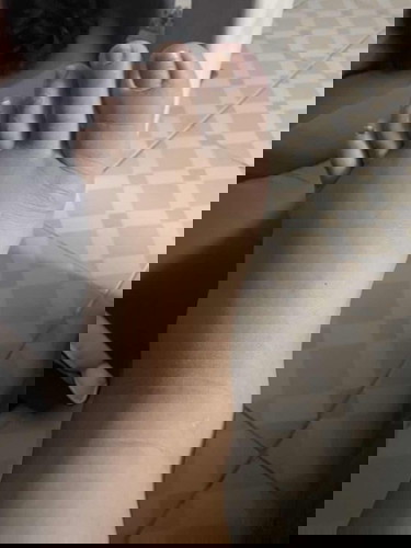 คลอดเเล้วแต่เท้าบวมหนักมาก