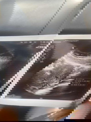 หมอบอกตั้งครรภ์ 5wเจอถุงแต่ไม่เจอตัว แบบนี้ปกติไหมคะ