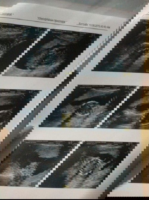 ตรวจเจอถุงน้ำในครรภ์ตอน5เดือนและทารกตัวบวม