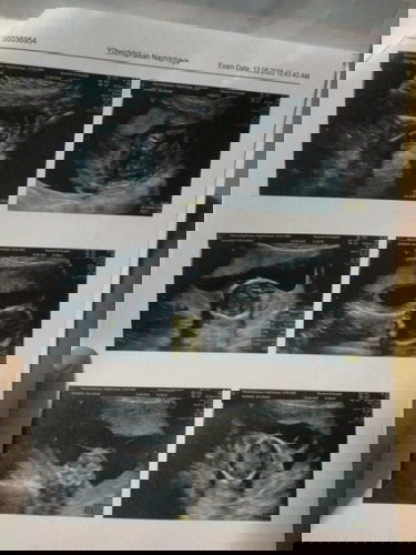 ตรวจเจอถุงน้ำในครรภ์ตอน5เดือนและทารกตัวบวม