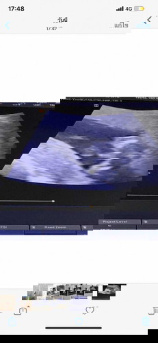 ท้องแรก 18 w4D