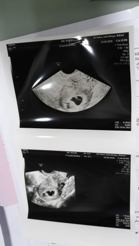 Hamil setelah keguguran