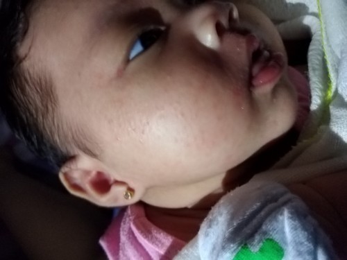 Rashes sa face