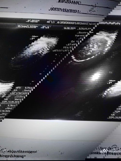 hasil USG 35-36 mnggu