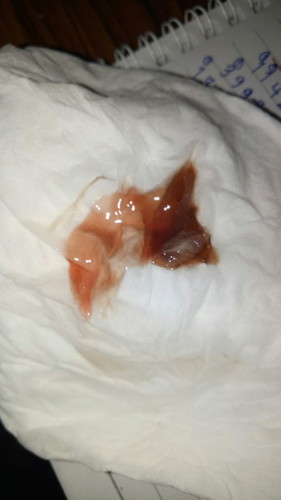 เลยกำหนดคลอด