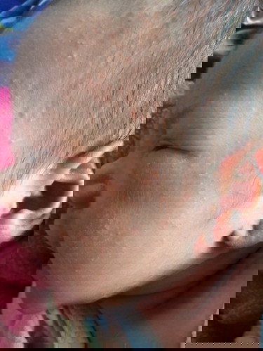 เเม่ๆค่ะน้องเป็นเเบบนี้เป็นอันตรายต่อน้องไหมค่ะเเล้วต้องใช่อะไรค่ะเเม่