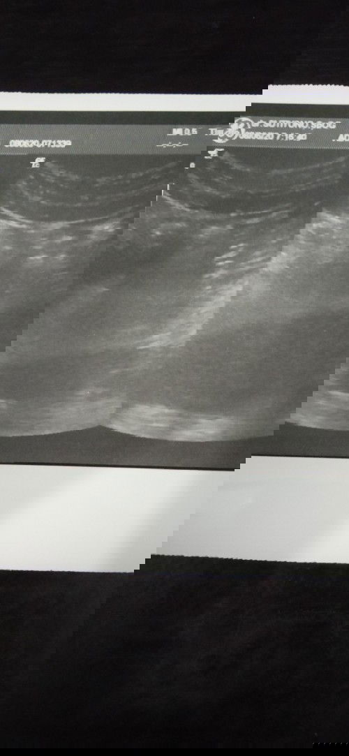 Kapan sebaiknya USG lagi?