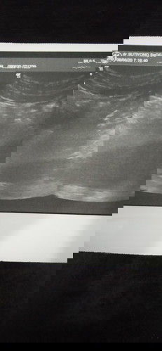 Kapan sebaiknya USG lagi?