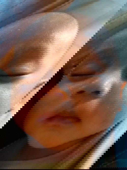 menghilangkan bercak2 putih di wajah bayi agar kembali rata