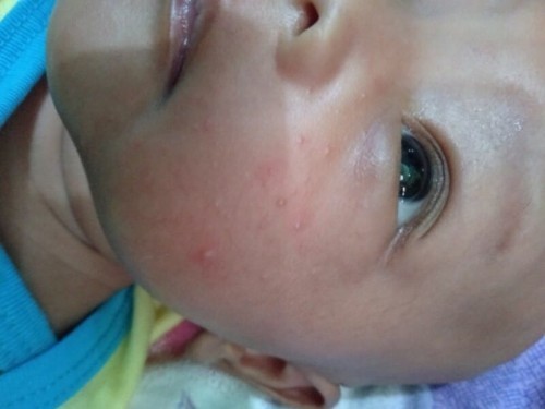 bruntusan pada bayi