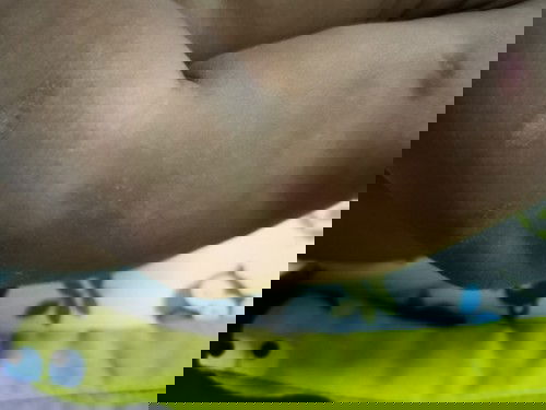 Kulit kering atau panau?