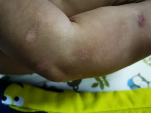 Kulit kering atau panau?