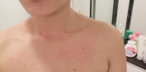 ถามแม่ๆค่ะ ผื่นแบบนี้อันตรายมั้ยคะ บางคนบอกเป็นผื่นฮอร์โมน แต่คันยิบๆตลอด ท้องแรก 5 weeks ค่ะ