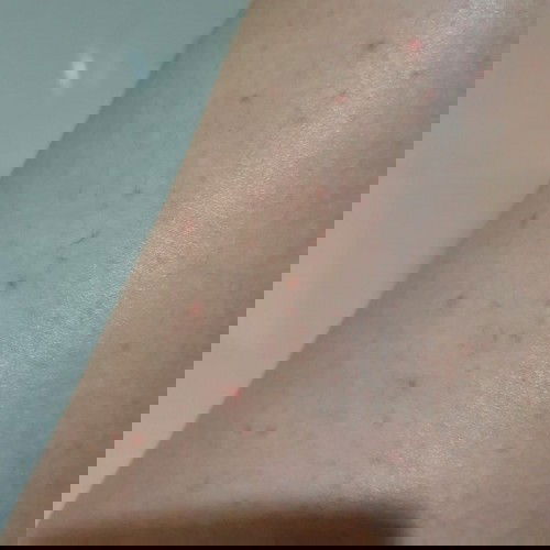 แพ้ท้อง หรือท้องแล้วแพ้?