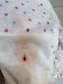 Blood discharge